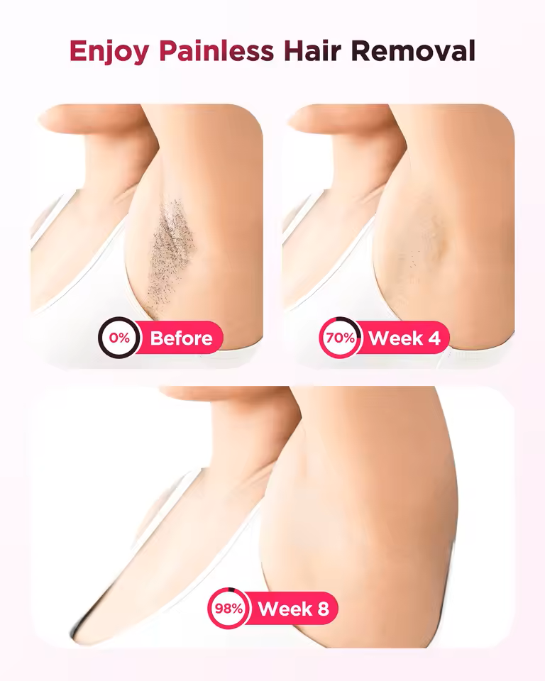 Nexalure Ice-Cooling IPL Hair Removal Device